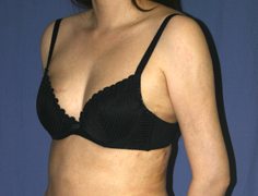 Liposuction After