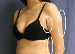 Liposuction Before