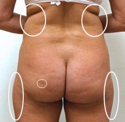 Liposuction Before