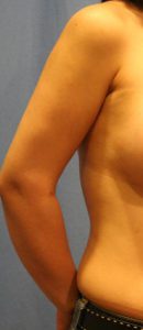 Liposuction After