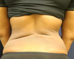 Liposuction After