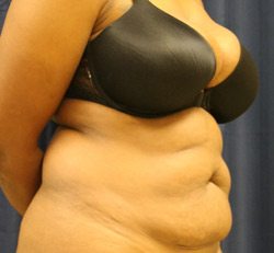 Liposuction Before