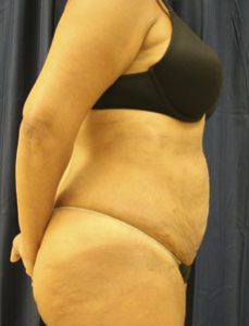 Liposuction After