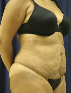 Liposuction After