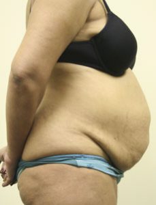 Liposuction Before