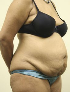 Liposuction Before