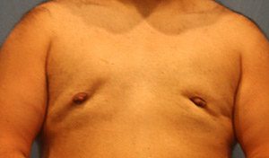 Liposuction Before