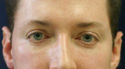 Lower Eyelid After