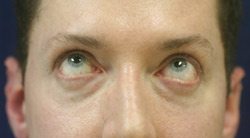 Lower Eyelid Before