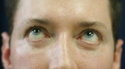 Lower Eyelid After