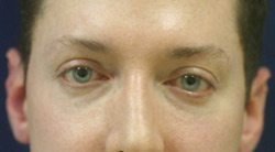 Lower Eyelid Before