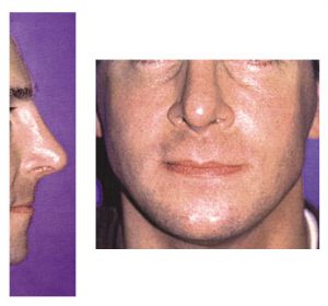 Rhinoplasty After