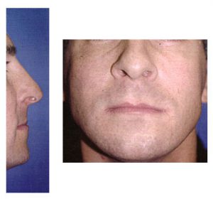 Rhinoplasty Before