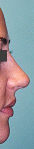 Rhinoplasty After