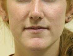 Rhinoplasty After