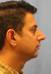 Rhinoplasty After