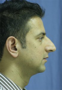 Rhinoplasty Before