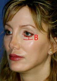 Best Muscle Lift After Pic. This patient has received the very best midface lift and brow lift by world renowned plastic surgeon Dr. Michael Byun.