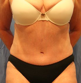 Patient after a successful tummy tuck with world renowned plastic surgeon Dr. Michael Byun