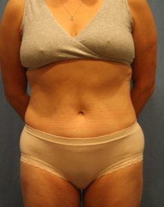 Patient after a successful tummy tuck with world renowned plastic surgeon Dr. Michael Byun