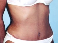 Patient after a successful tummy tuck with world renowned plastic surgeon Dr. Michael Byun