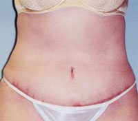 Patient after a successful tummy tuck with world renowned plastic surgeon Dr. Michael Byun