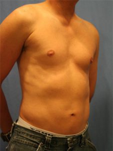 Liposuction After