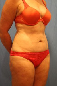 Liposuction After