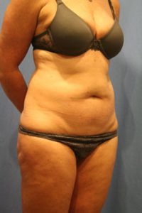 Liposuction Before