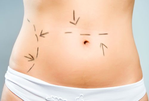 The best tummy tuck, also known as an abdominoplasty, is done by tightening the muscles of the abdomen