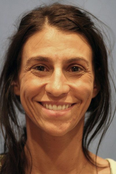 Best Facelift Before Pic. This patient is about to get the very best facelift procedure by Dr. Michael Byun.